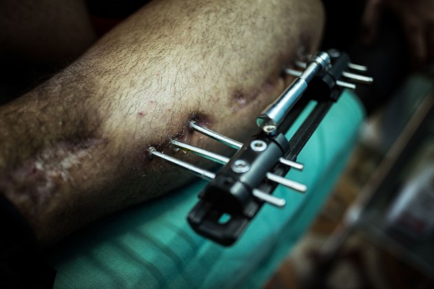 &copy; Darrian Traynor, from the series, 'More than skin deep'. GAZA. 3rd March 2020. A patient waits to have physiotherapy at the M&eacute;decins Sans Fronti&egrave;res / Doctors Without Borders (MSF) clinic in Gaza.