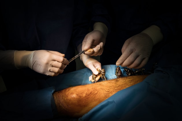 &copy; Darrian Traynor, from the series, 'More than skin deep'. GAZA. 4th March 2020. Surgeons begin to remove Ismail Abu Wared&rsquo;s external fixator. Al-Awda hospital patients suffering from osteomyelitis are kept in isolation rooms to treat infection. No new bone plantations can be performed while the infection is present.